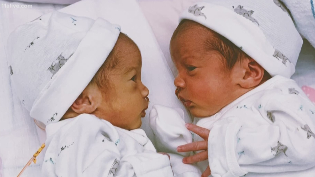 Monochorionic Diamniotic Twins 1 - 2025-05-21T134456.588