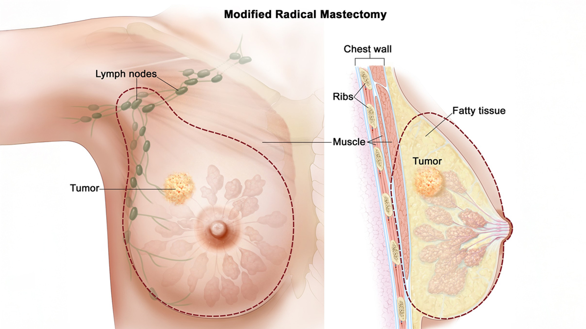 Double Mastectomy 1 - 2025-05-22T152434.495
