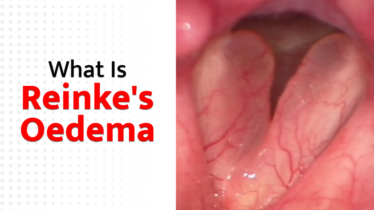 Reinke's Oedema 2 - 2025-05-22T135222.446