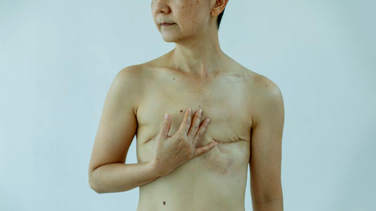 Double Mastectomy 2 - 2025-05-22T152436.282