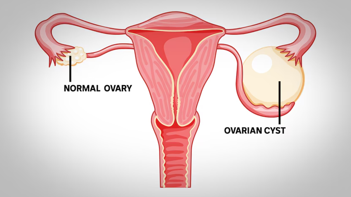 cysts in ovary 2 - 2025-05-22T153655.000