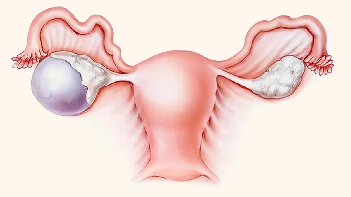 what causes cysts in ovaries 3 - 2025-05-22T153657.383