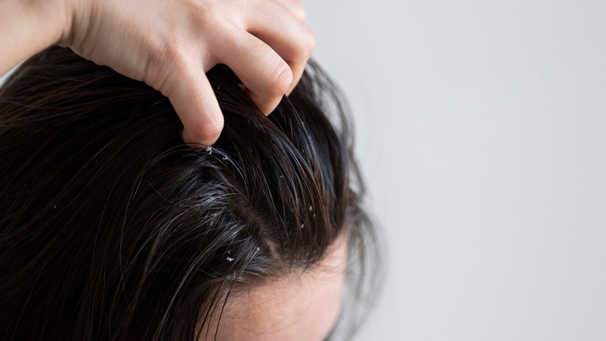 dandruff