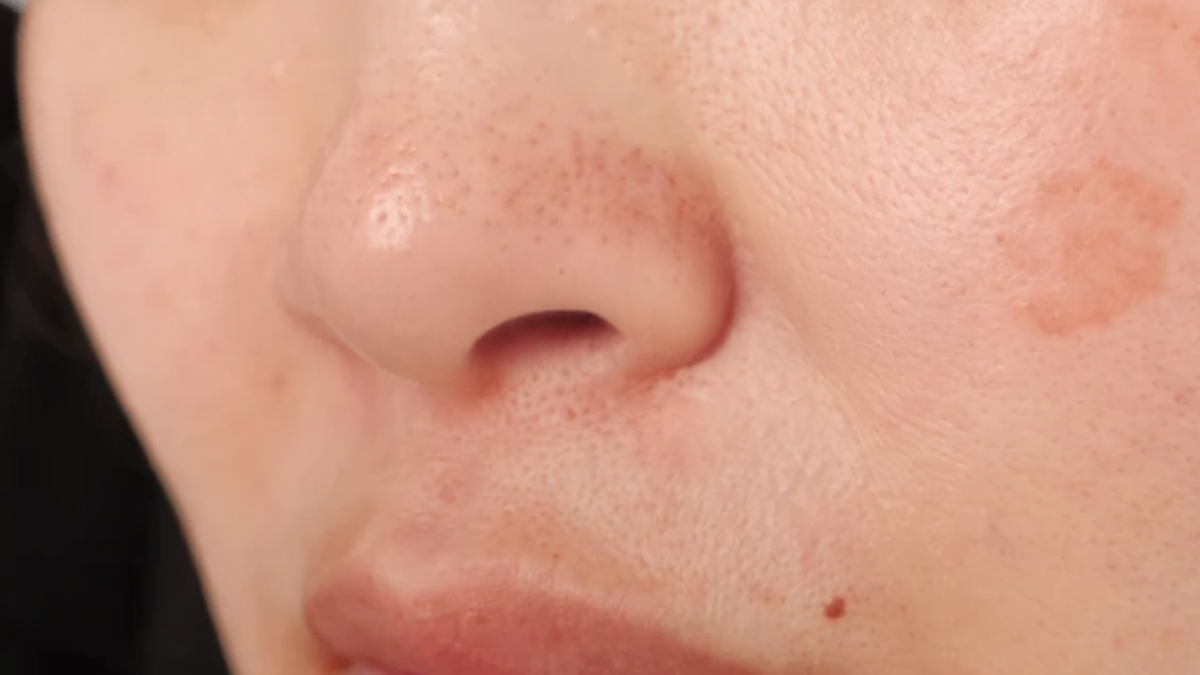 clogged-pores