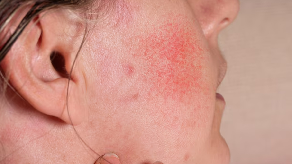 inflamed-skin