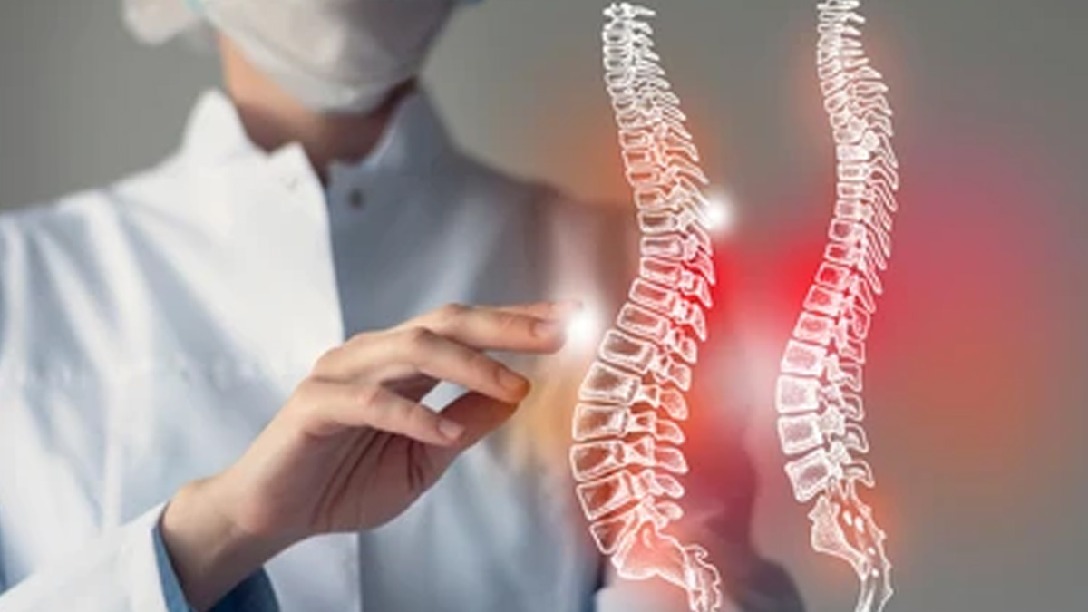 kyphosis