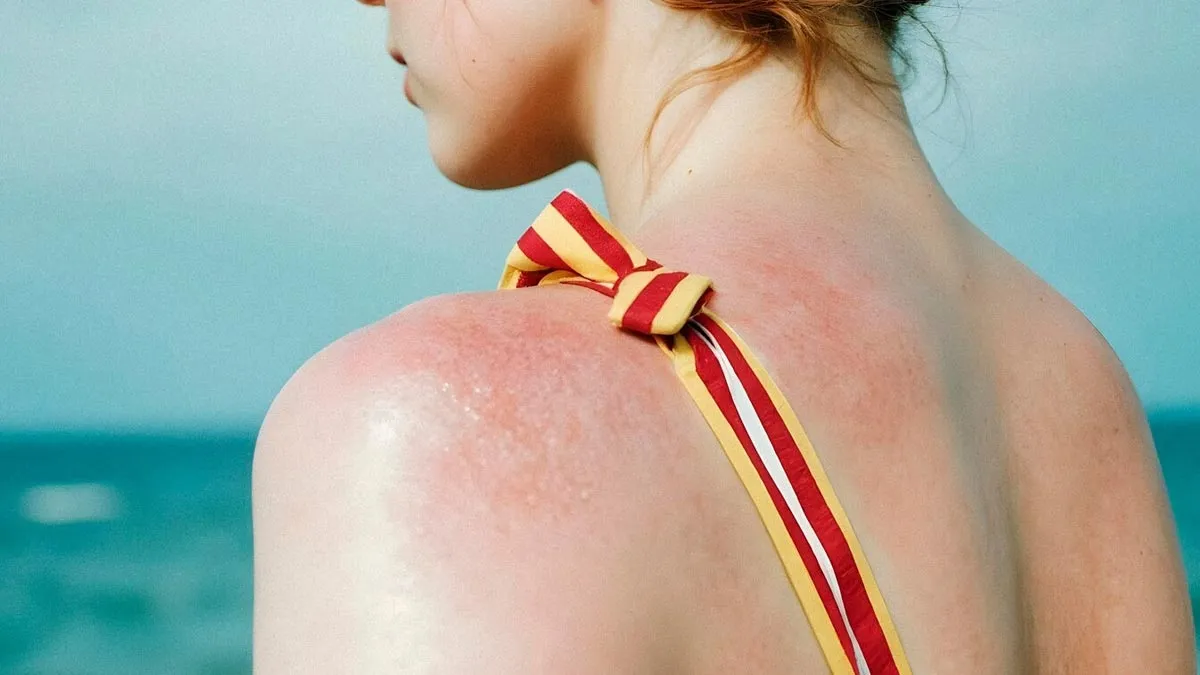 Watch Out For Swimmer's Itch This Summer: Signs And Preventive Measures