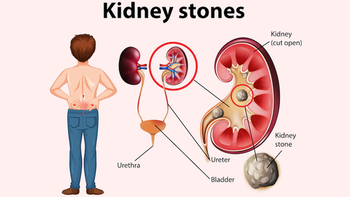 kidney-stones