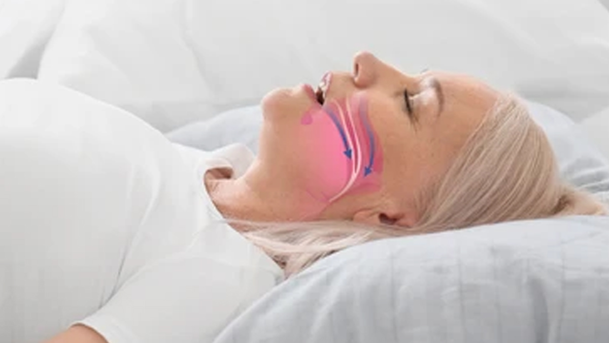 sleep-apnea
