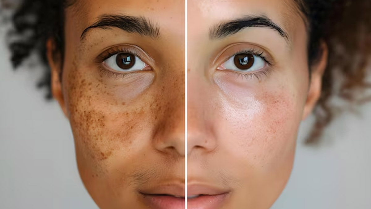 Melasma Reduction: How To Best Protect Your Skin From The Sun
