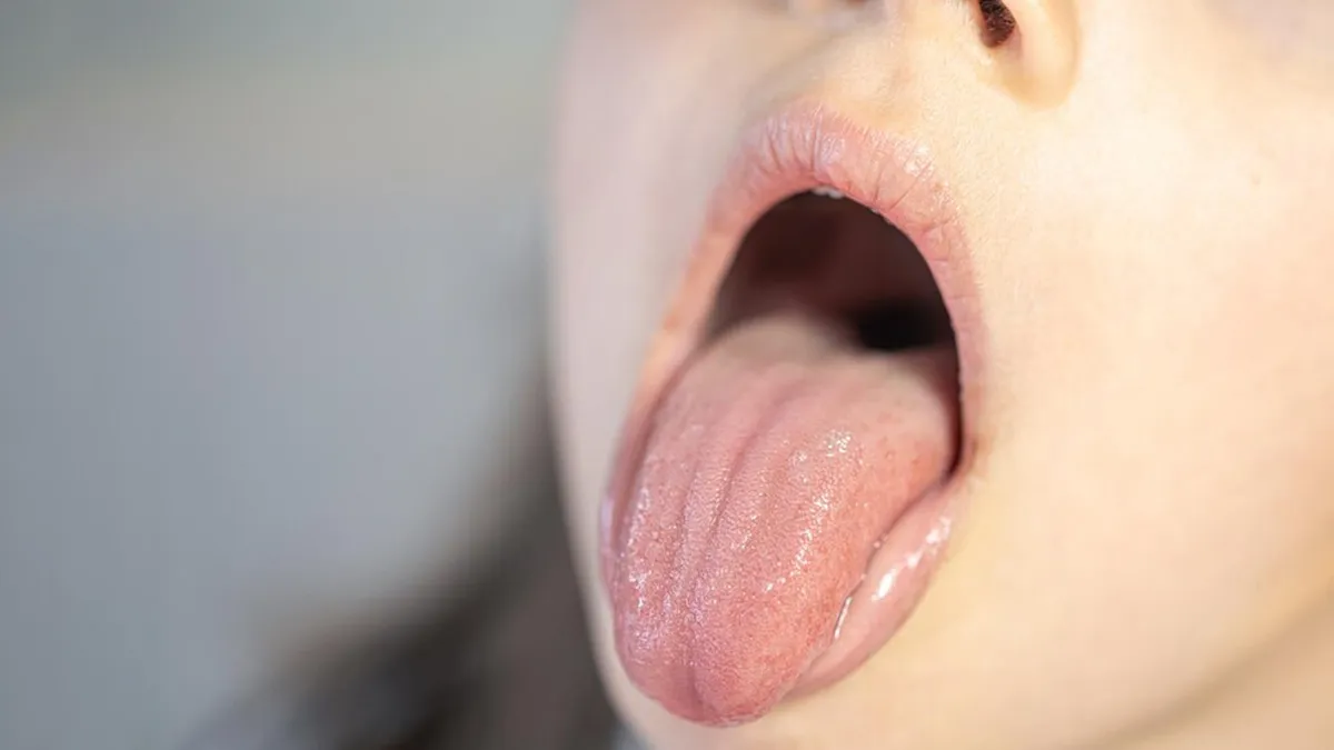What Should You Eat When You Have Mouth Ulcers? Expert Answers