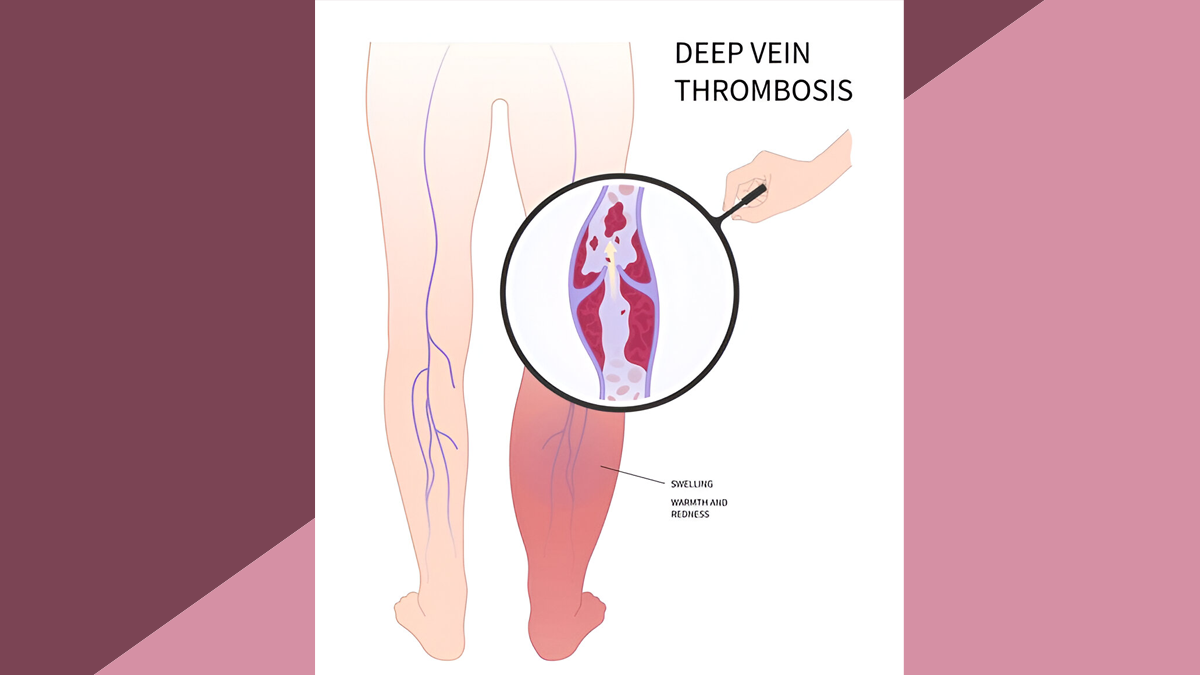 Deep-Vein-thrombiosis