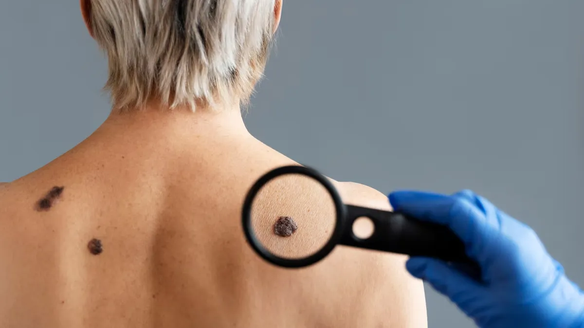 Skin Cancer Affects Different Parts Of The Body In Men And Women; Here's What Study Reveals