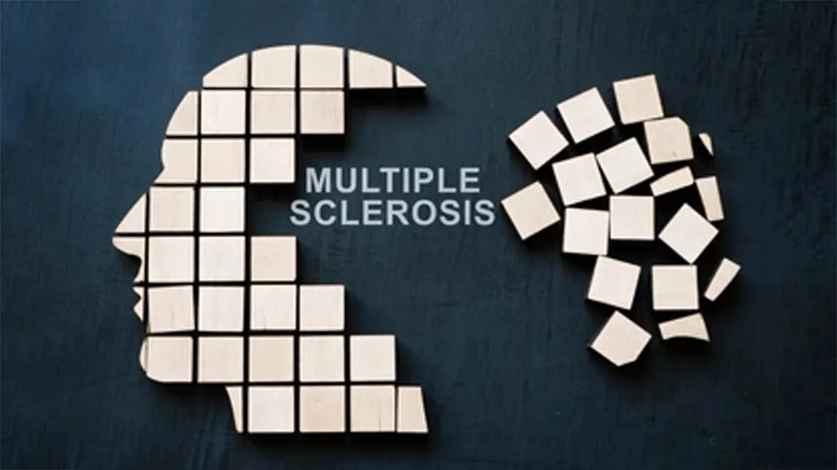 From Numbness To Brain Fog: Expert Lists Early Signs Of Multiple Sclerosis You Should Watch Out For
