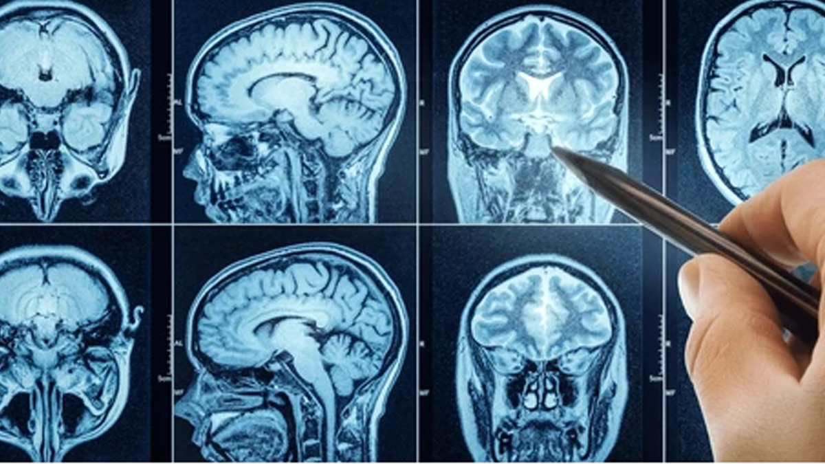 Diffuse-Intrinsic-Pontine-Glioma