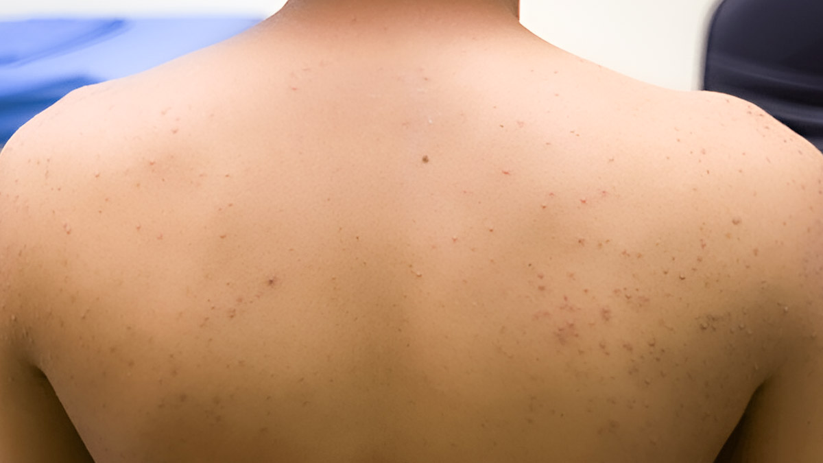Natural Care: Home Remedies To Prevent And Treat Folliculitis