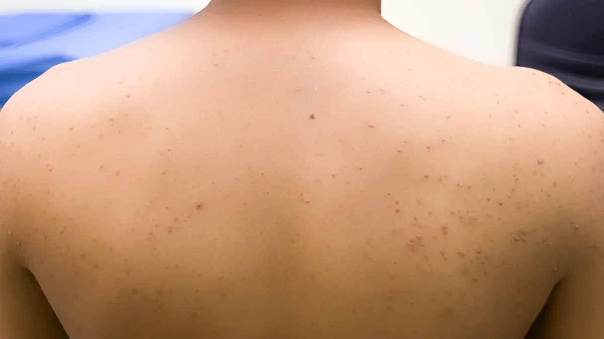 Natural Care: Home Remedies To Prevent And Treat Folliculitis