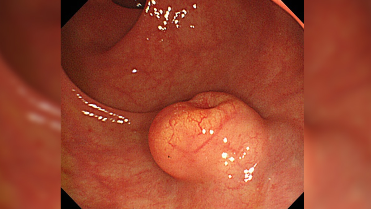 Neuroendocrine Colon Cancer 2 - 2025-06-03T124432.159