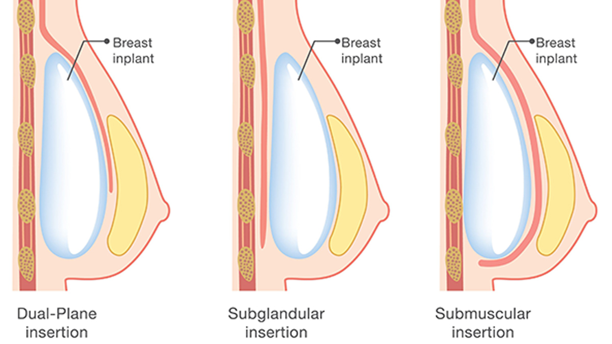 dual plane breast augmentation 2 - 2025-06-04T130757.695