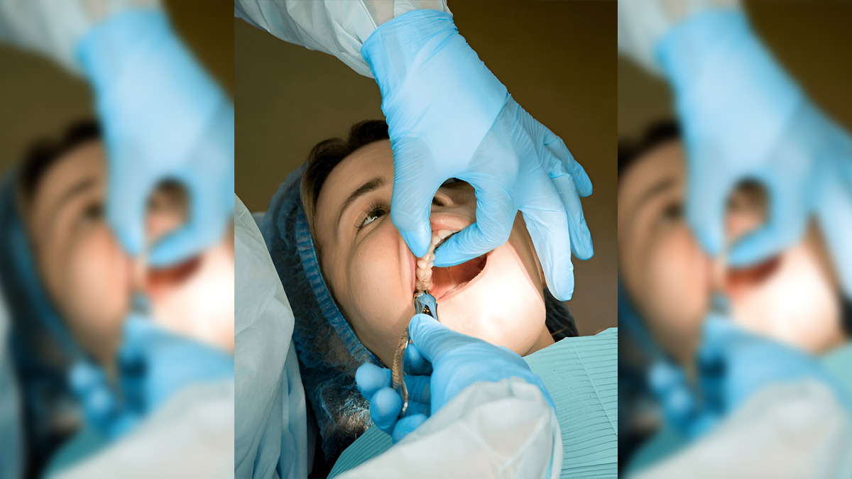 wisdom-tooth-extraction