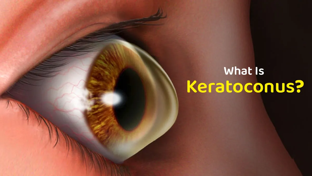 Is Keratoconus a Serious Eye Disease? Here’s What You Need to Know