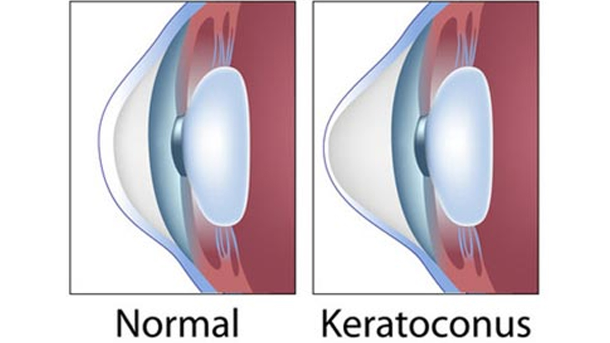 Keratoconus 1 - 2025-06-05T121250.624