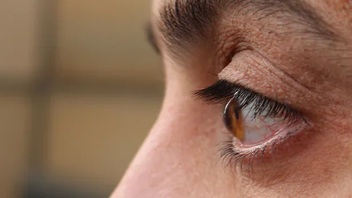 Keratoconus 2 - 2025-06-05T121255.302