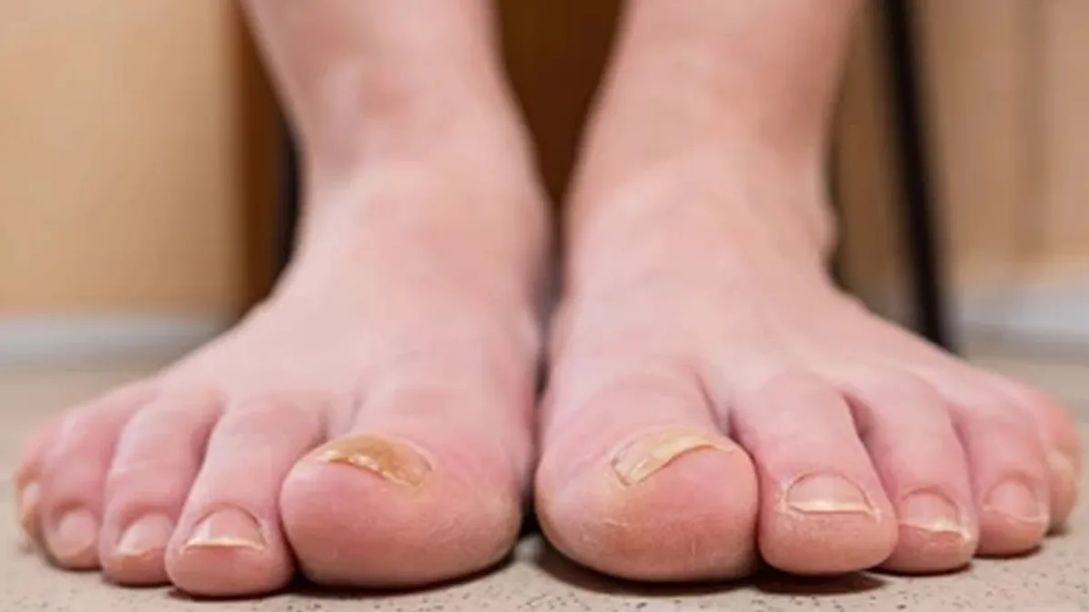 Toenail Trauma From Flip-Flops: How To Spot Early Signs And Treat Them