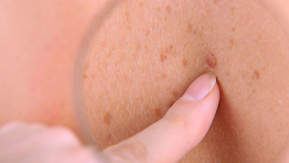 skin cancer recur  2 - 2025-06-09T093036.422