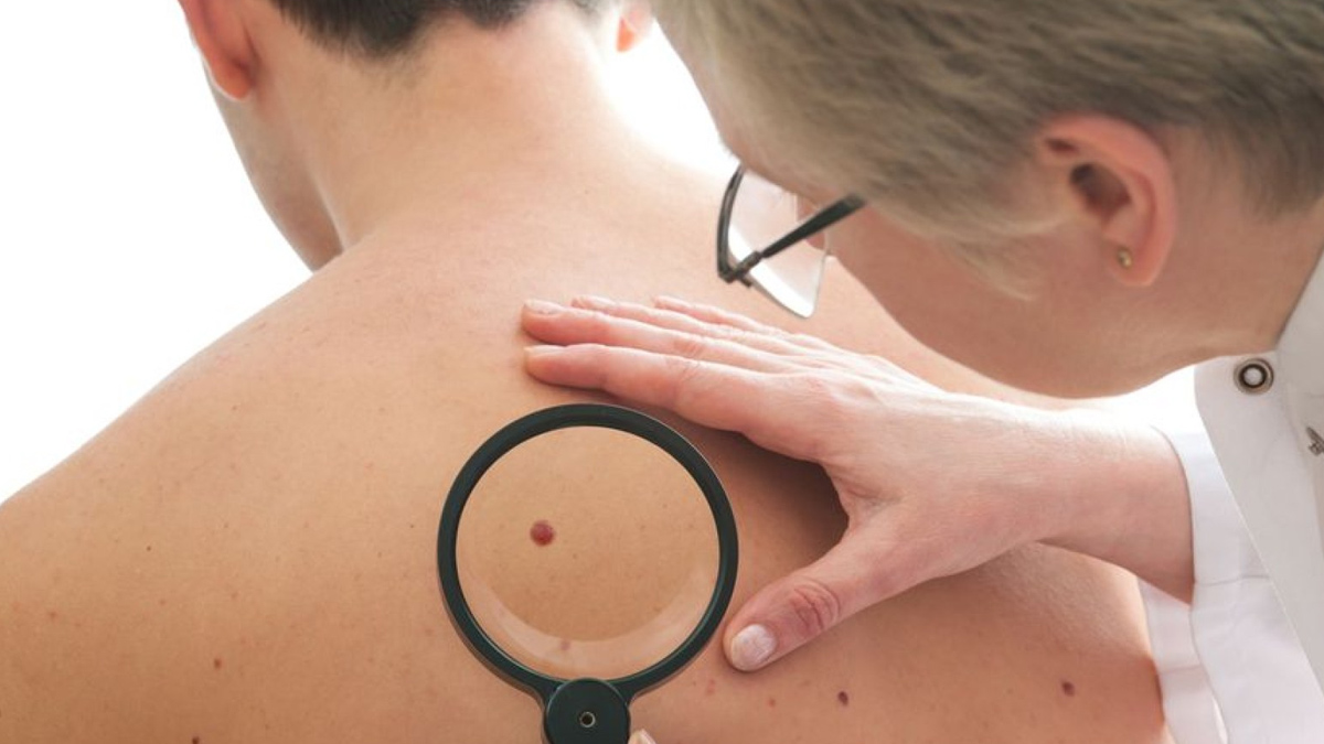 skin cancer recurrence  3 - 2025-06-09T093034.728