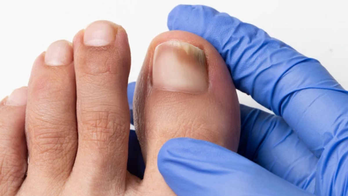 toe-nail-discolouration
