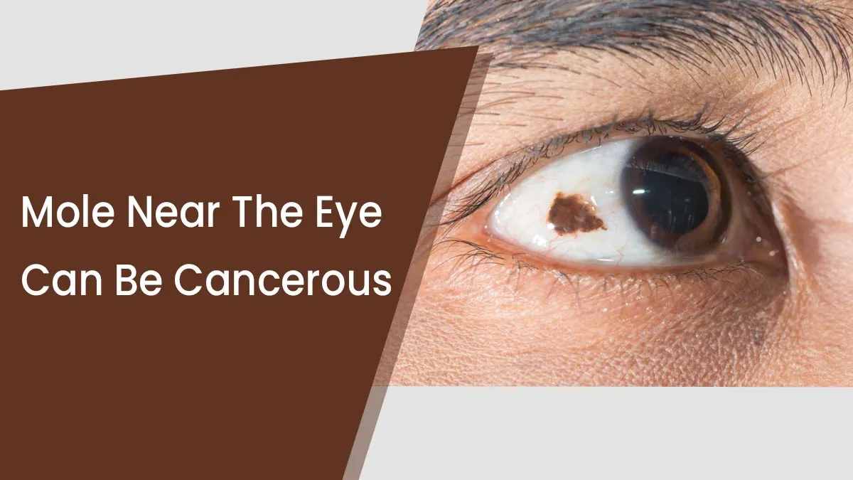 Junctional Nevus Near the Eye: Expert Shares Causes, Risks, and When to Seek Medical Advice