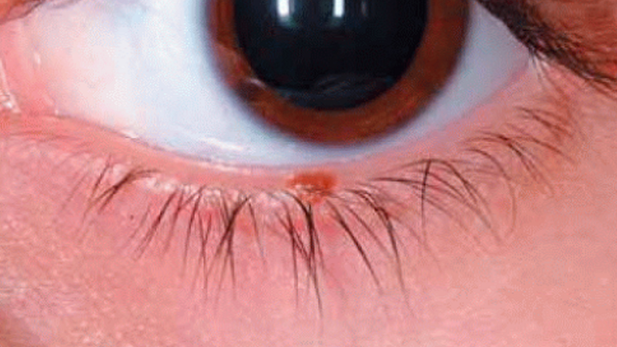 mole near the eye 1 - 2025-06-10T120808.792