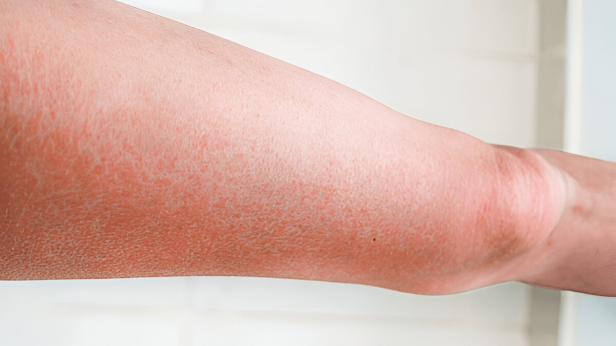 lymphedema-in-cellulitis