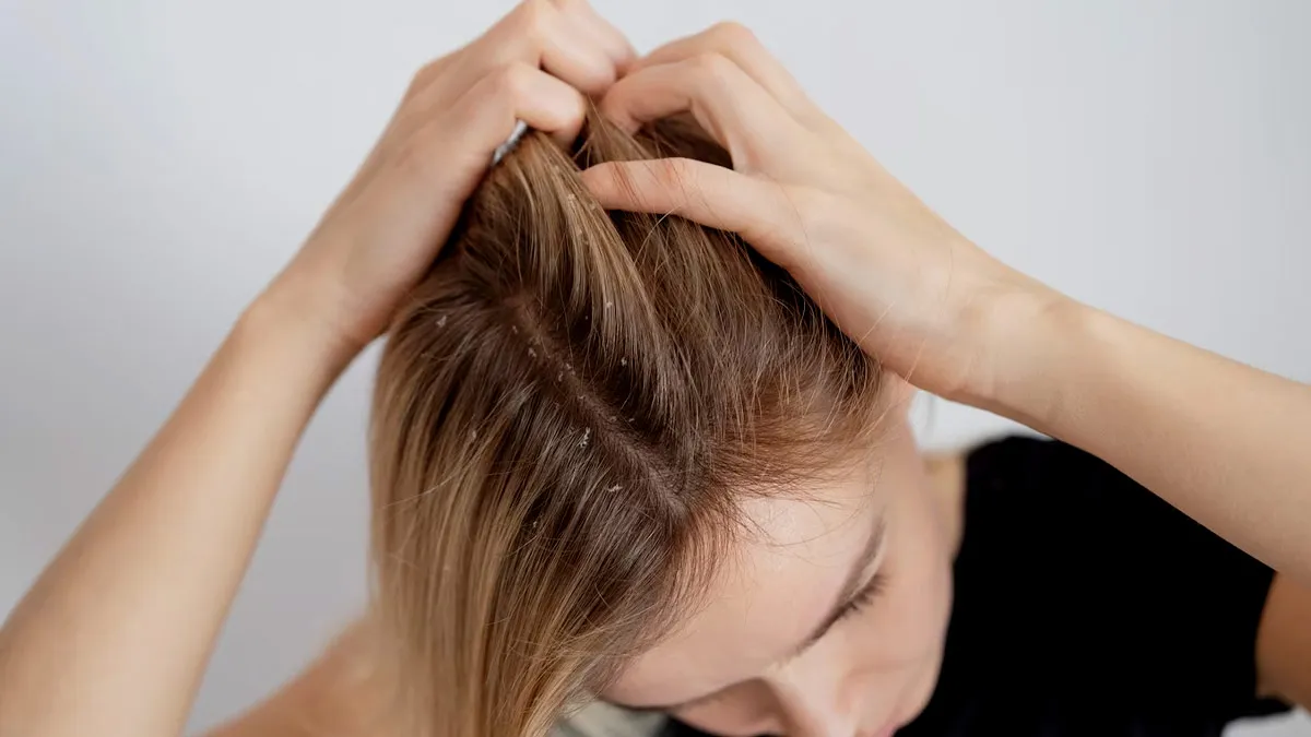 Beat the Heat: 5 Home Remedies for Immediate Relief from Itchy Scalp