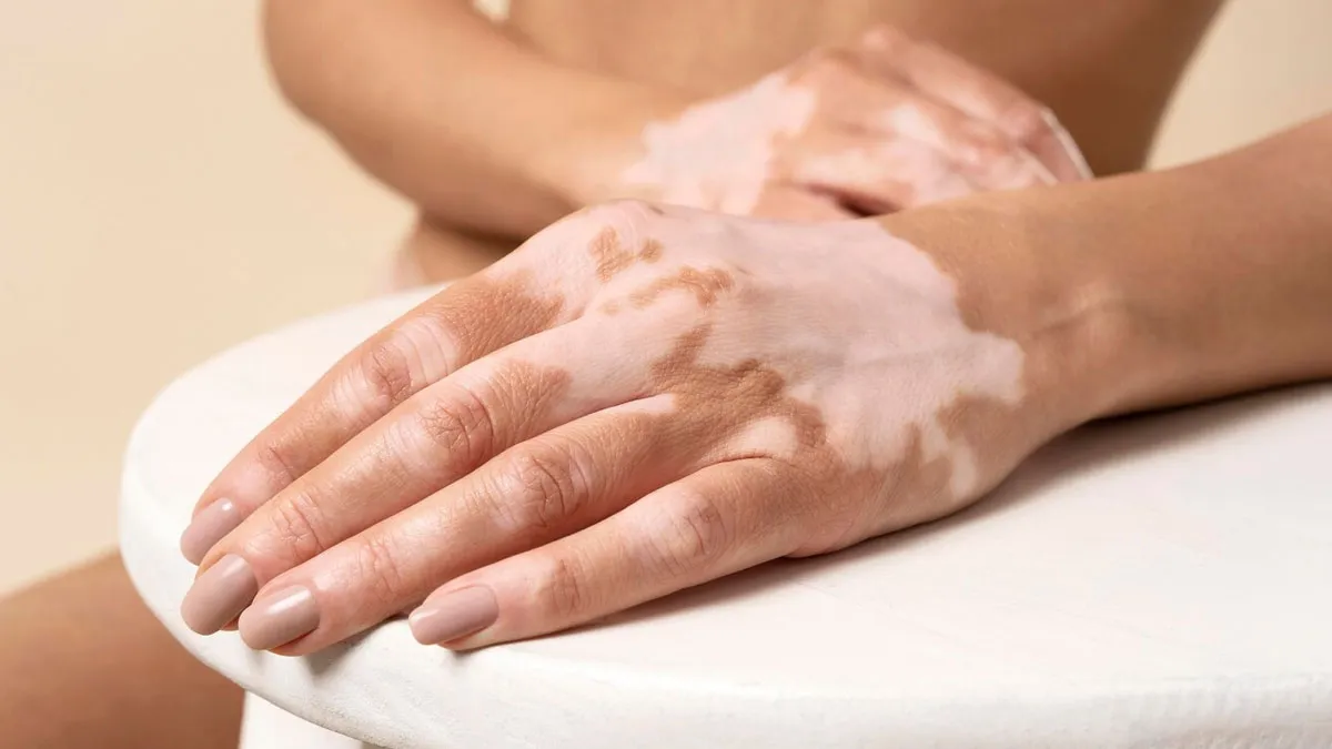 Vitiligo Isn’t Contagious — And 3 Other Myths Debunked