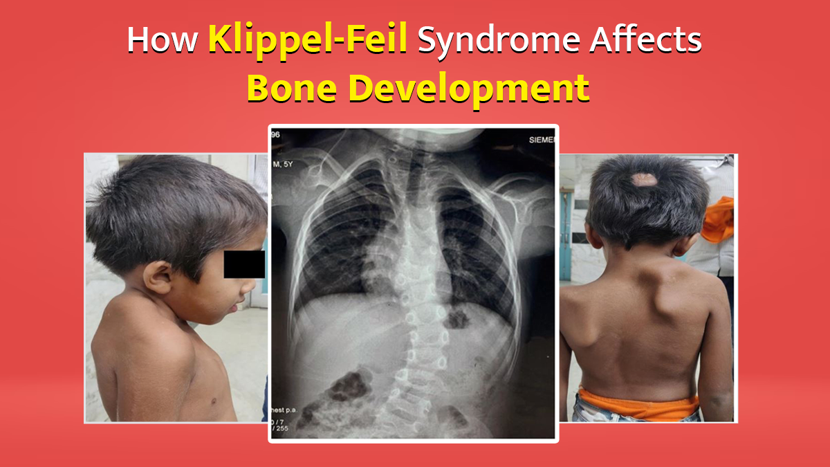 What Is Klippel-Feil Syndrome? How It Affects Neck Bone Development ...