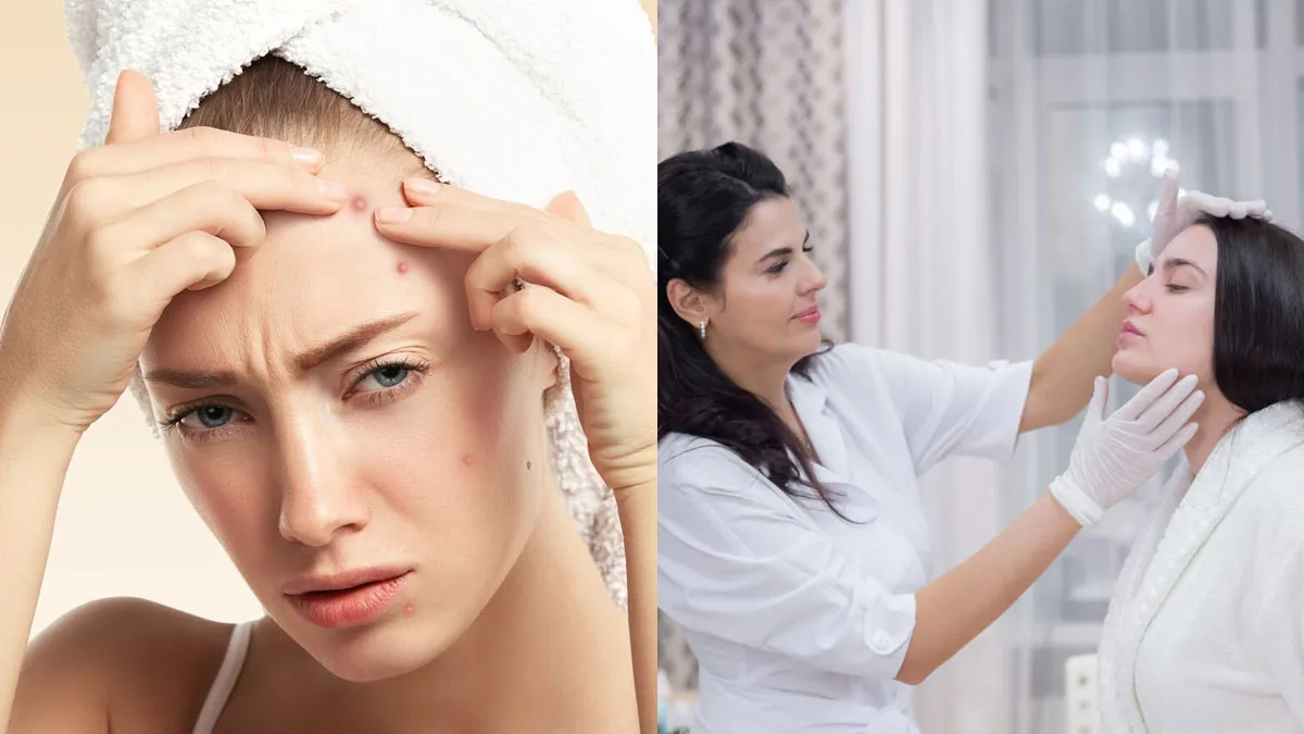 Acne Awareness Month: Understanding Physical and Mental Effects of Acne Scarring