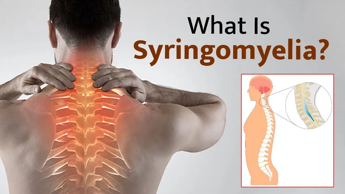 What Is Syringomyelia? Spine Surgeon Explains How Fluid-Filled Cysts Affect the Spinal Cord