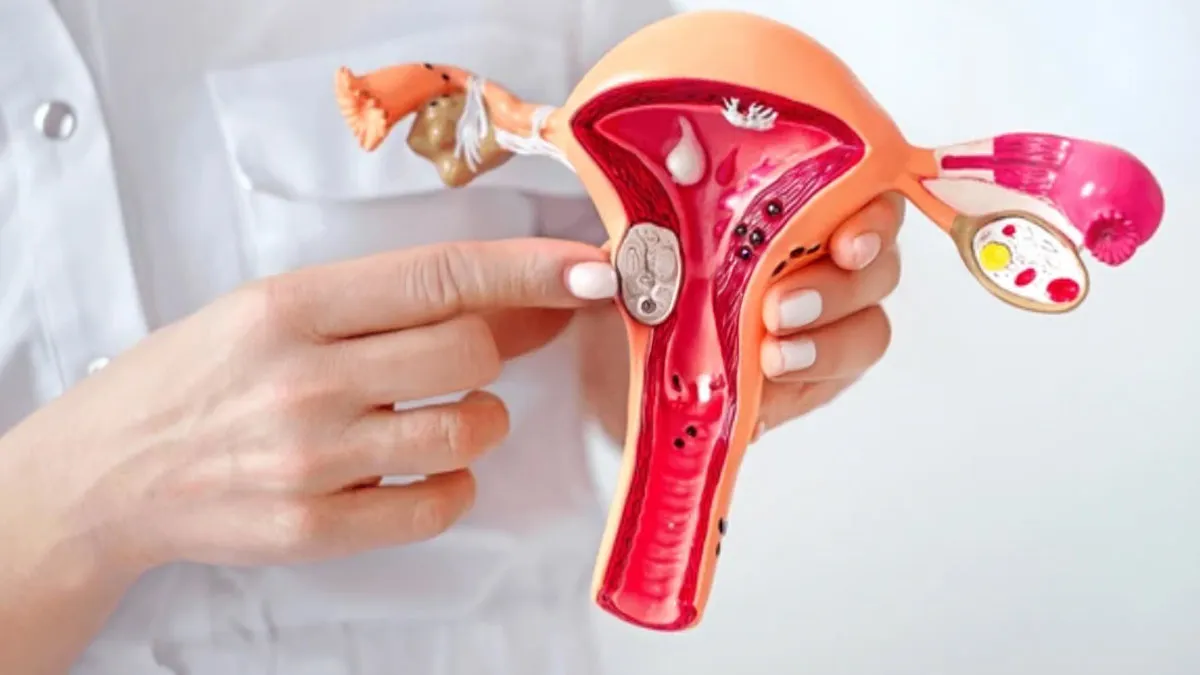 Fibroids On The Rise: Expert Explains The Alarming Increase Of Fibroids Among Young Indian Women