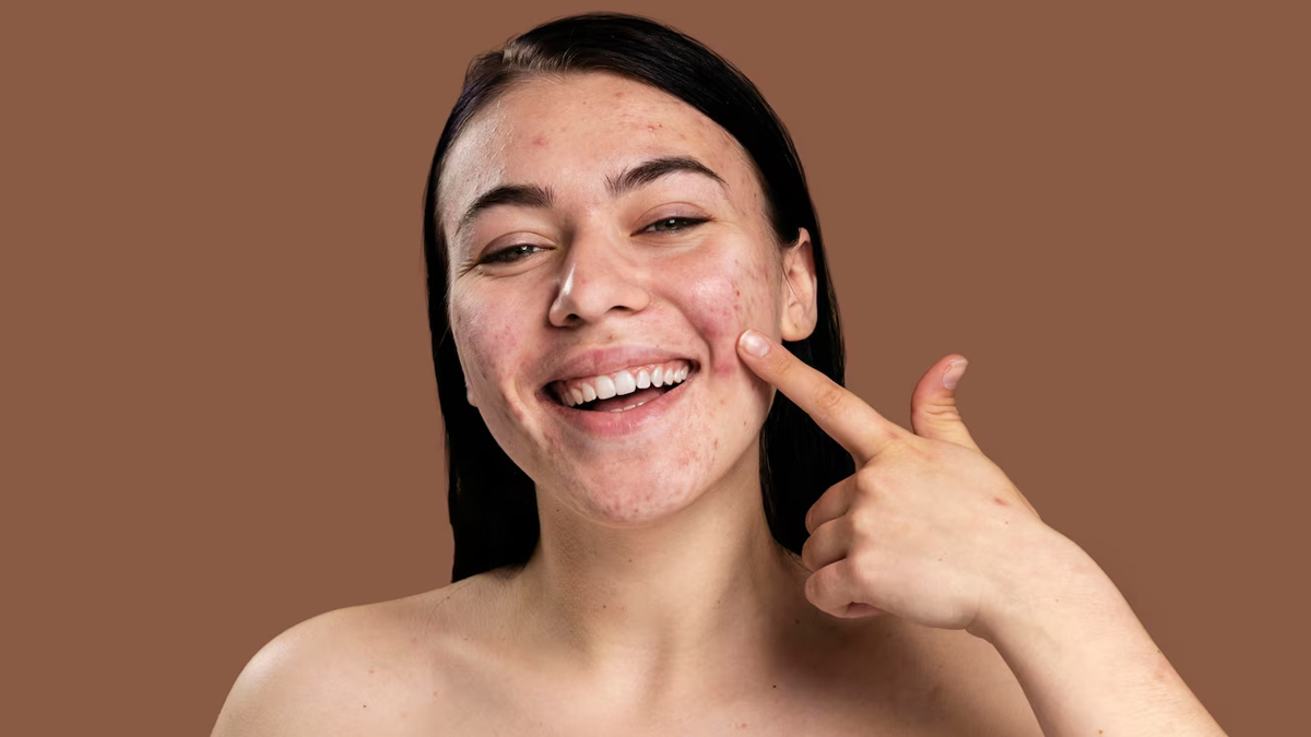 Acne scars turned into confidence