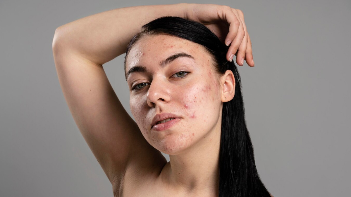 Acne scars