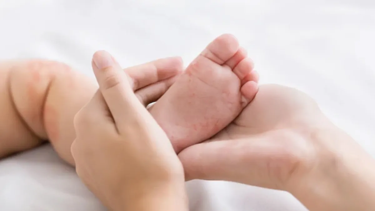 US Measles Outbreak: Nearly 1,200 Cases Reported, 34 States Affected, And 3 Deaths