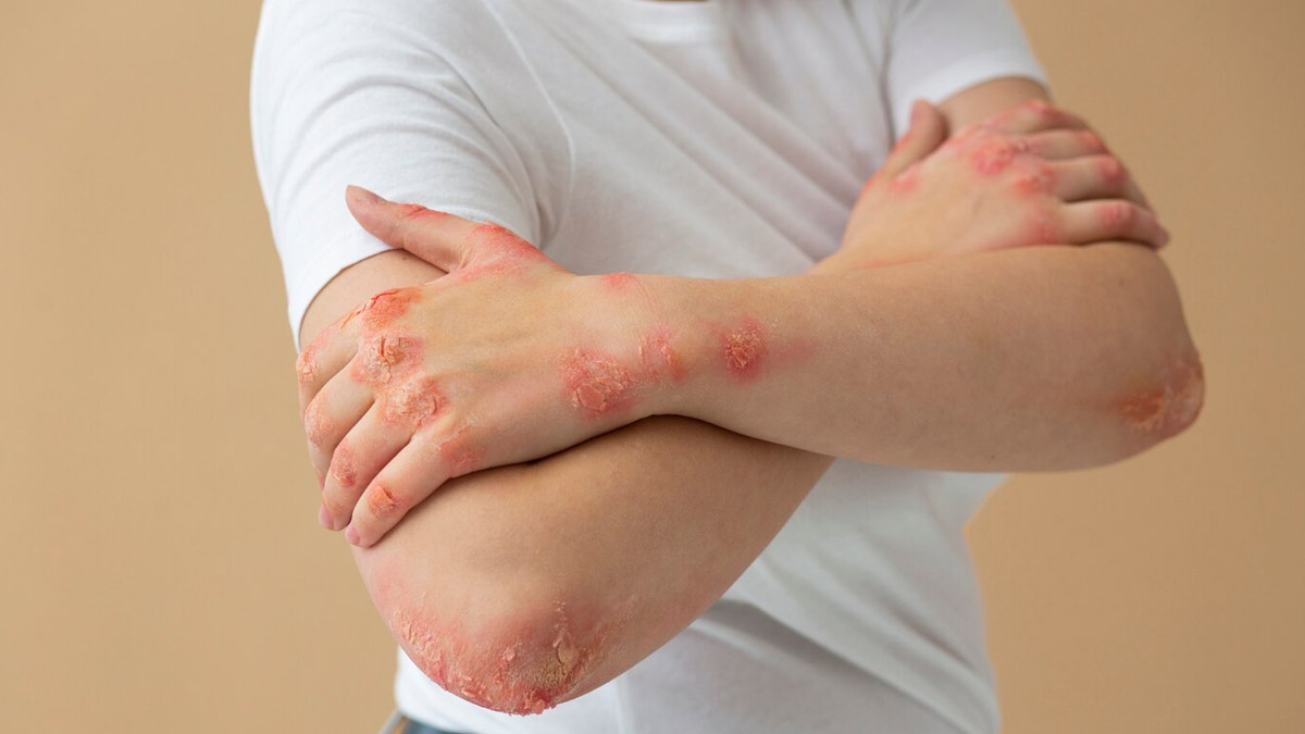 mn-psoriasis-treatment