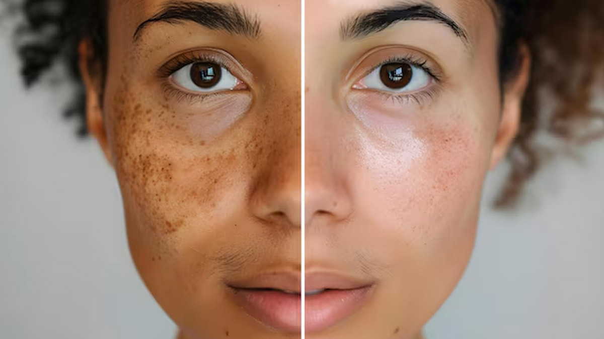 Skincare Ingredients That Can Reduce Dark Spots On Your Face