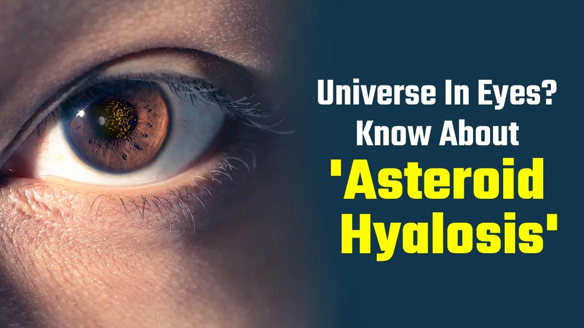 When Your Eyes Hold a Universe: What Is Steroid Hyalosis and Why Some Eyes Sparkle Like the Night Sky
