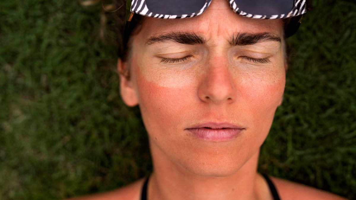How To Make A Post-Sun Recovery Face Pack That Doesn’t Burn Your Skin Barrier