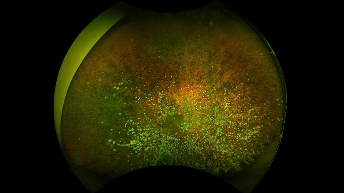 steroid hyalosis in eyes 2 - 2025-06-19T153641.627