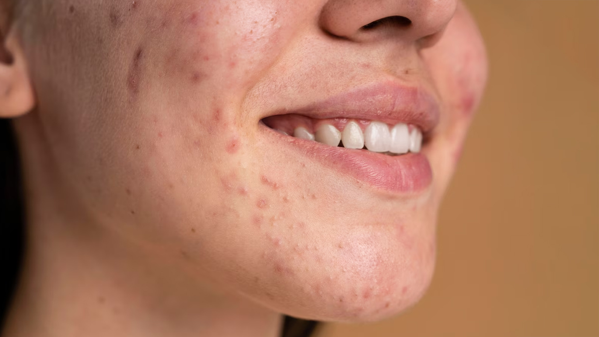 acne