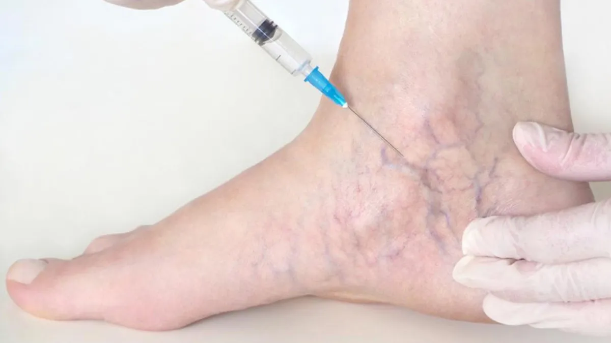 Can an Injection Remove Varicose Veins? Doctor Explains Sclerotherapy and Its Function